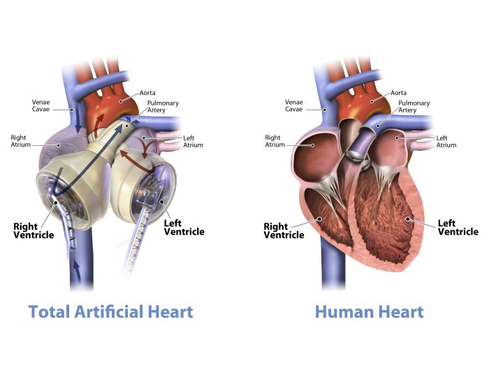 graphic_of_the_syncardia_temporary_total_artificial_heart_beside_a_human_heart